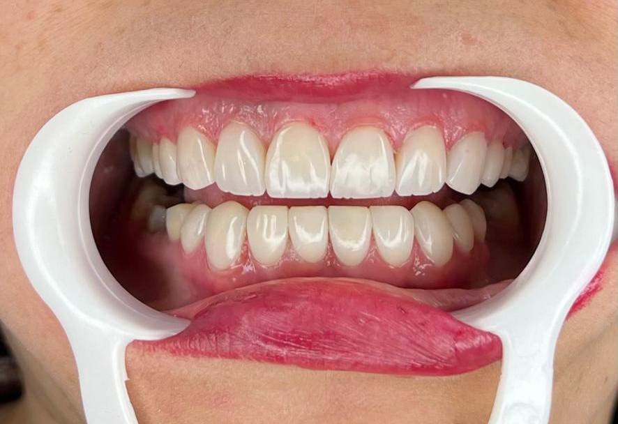 بعد کامپوزیت دیاستم بعد کامپوزیت دیاستم