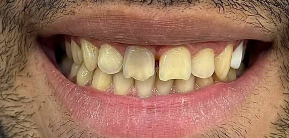 قبل کامپوزیت قبل کامپوزیت