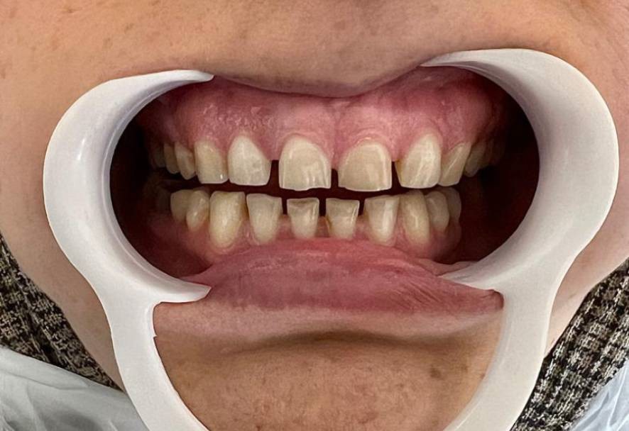 قبل کامپوزیت یرای دیاستم قبل کامپوزیت یرای دیاستم